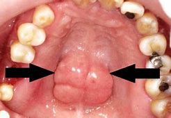 Langit Langit Mulut Bengkak
